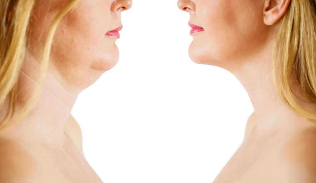 Double Chin treatment Rochdale before and after results