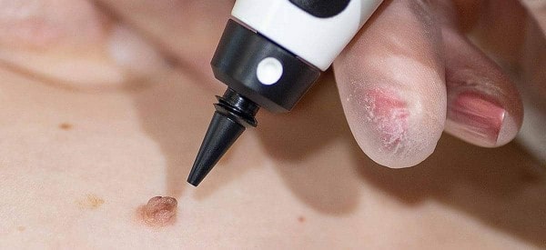After Skin Tag Removal Rochdale