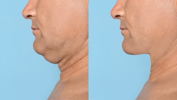 Which Non-Surgical Treatments Work Best for Jowls and Loose Skin Rochdale?