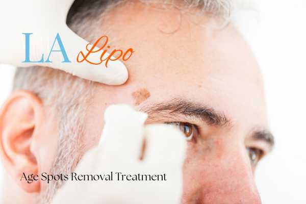 What Are the Most Effective Treatments for Age Spots Rochdale?