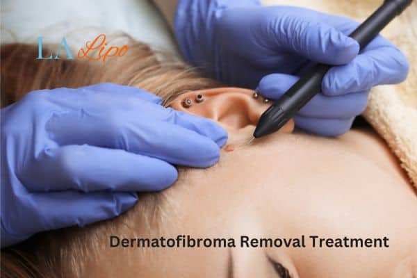 Dermatofibroma Removal Treatment Rochdale