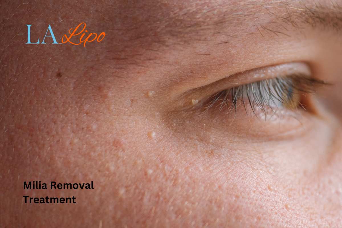 Cryopen Milia Removal: Is It the Easiest and Safest Option Rochdale?