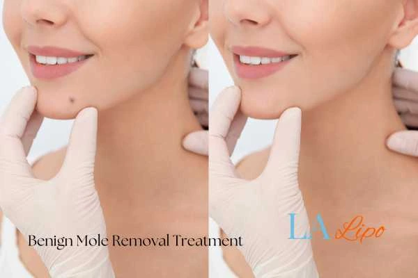 woman's before and after mole removal Rochdale results