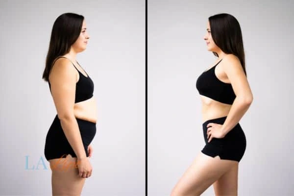 image of woman before and after results of LA-EMS Body Sculpting Rochdale to help treat Diastasis recti