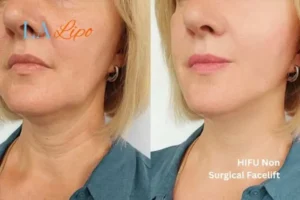 hi-fu for wrinkles Rochdale before and after results