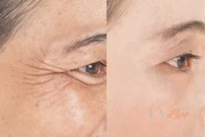 Before and after results of woman - HI-fu wrinkles reduction treatment Rochdale