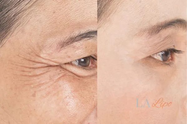 Before and after results of woman - HI-fu wrinkles reduction treatment Rochdale