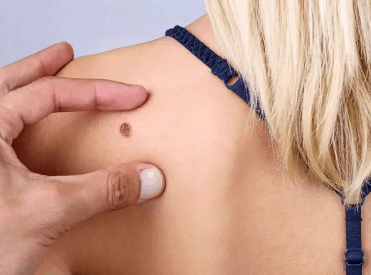 woman having mole removal Rochdale consultation before treatment.