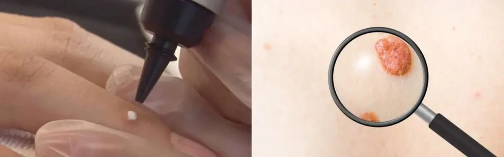 Cryopen for mole removal Rochdale - speak to our team today!