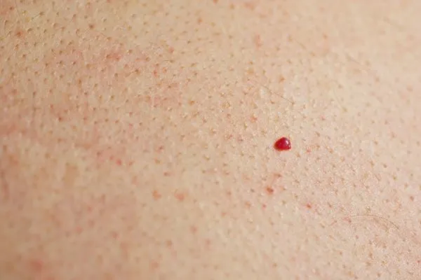 close up of a cherry angioma Rochdale