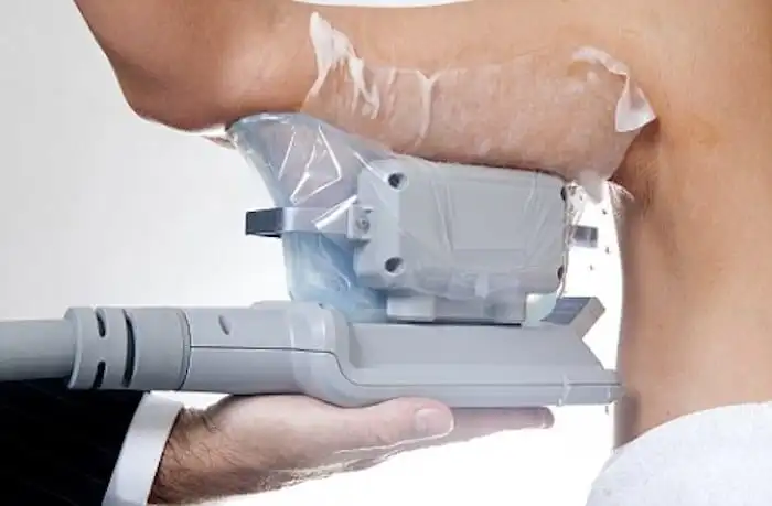Picture of fat freezing Rochdale on the upper arms.