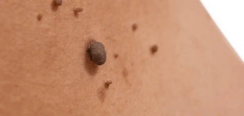 image of a skin tag Rochdale