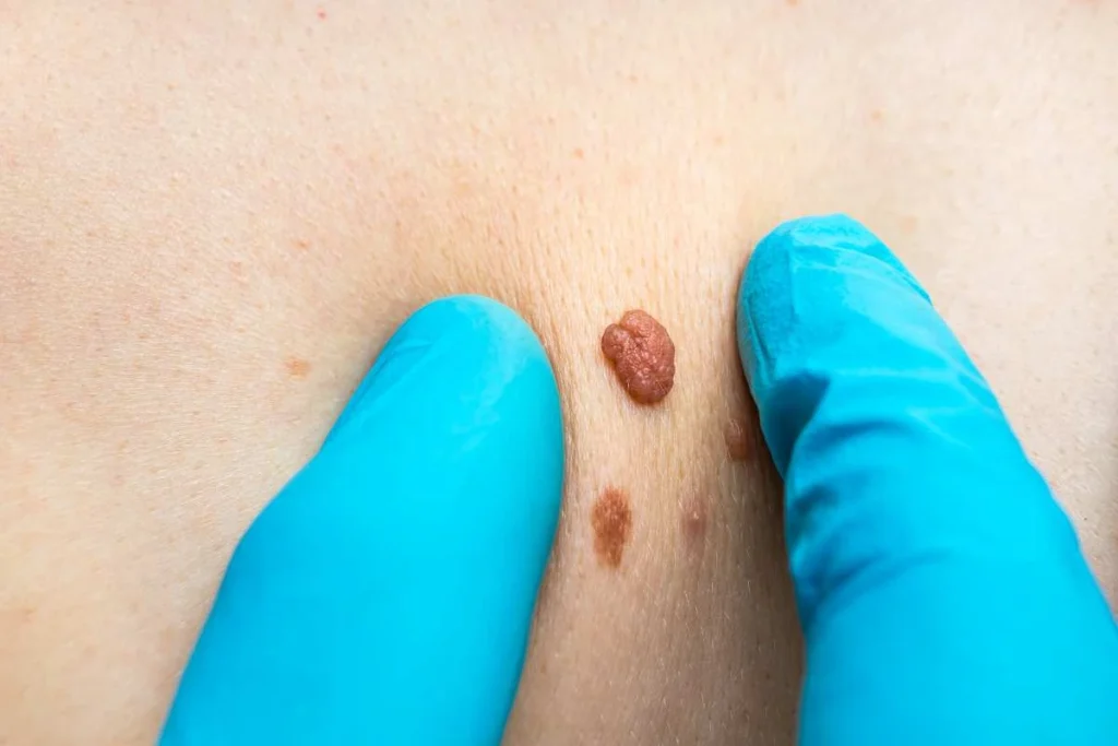 Consultant examining a skin tag Rochdale