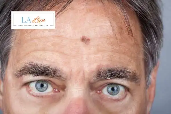 Solar Lentigo Removal Rochdale image of man with mark on his forehead