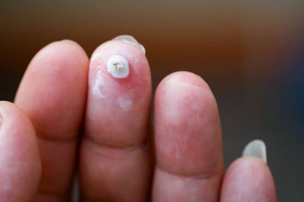 wart on person finger - cryotherapy to treat from LA LIPO Rochdale