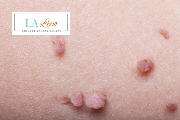 Does cryopen skin tag removal Rochdale hurt? Find out now call our team today!
