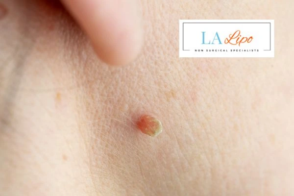 Book skin tag removal Rochdale today speak to our team now!