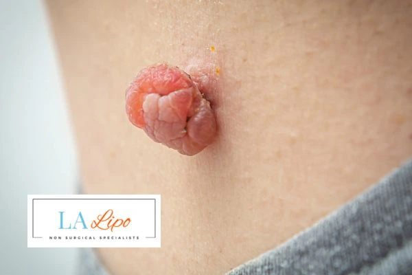 Interested in skin tag removal Rochdale? Concerned about the pain? Find out more today!