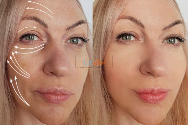 Morpheus 8 results Rochdale face lift.