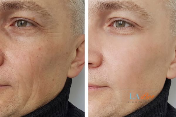 See the amazing results of Morpheus8 Treatment Rochdale!