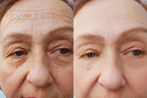 The powerful benefits of Morpheus8 Treatment Rochdale - Call Our team today!