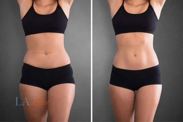 before and after results of non-surgical treatment to help a woman's body image and mental health Rochdale
