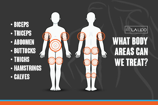 Diagram to show areas you can have LA-EMS Body Sculpting Treatment Rochdale