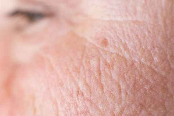close up picture of a woman's face showing an age spot Rochdale