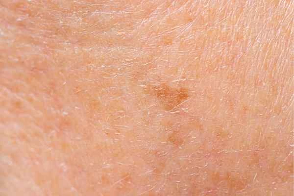close up picture of age spots Rochdale