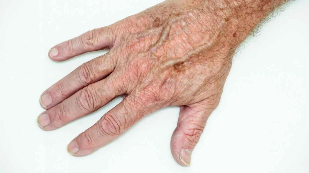 Male hand showing age spot Rochdale