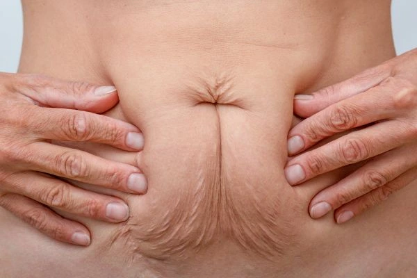 Should I Combine Diastasis Recti Treatment with Body Contouring for Better Results Rochdale?