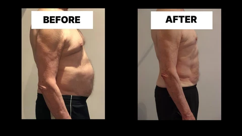 What Symptoms Can Diastasis Recti Cause in Men? Weak Core, Back Pain and Poor Posture Rochdale